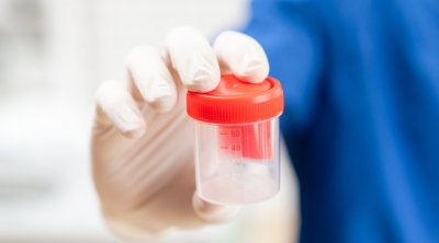 اكتشاف فيروس جدري القردة في السائل المنوي