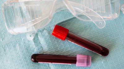 قريبا : إختبار الدم سيكشف الإصابة بالزهايمر 