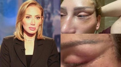 ريهام سعيد تبدأ تجميل تشوهات وجهها