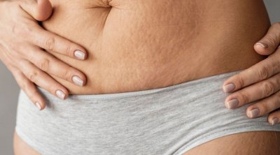 Vergétures : cet agrume capable de les atténuer
