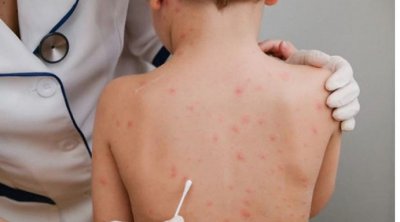 تونس لم تسجل أي إصابة بجدري القردة