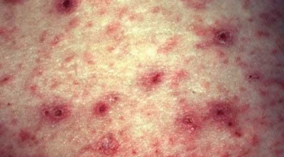 القصرين : اغلاق مدرسة ابتدائية في تالة بسبب اكتشاف 42 اصابة بداء "الجرب"