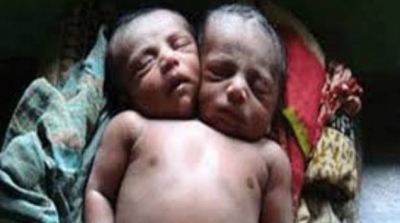 زيمبابوي : ولادة توأم برأسين وجسد واحد