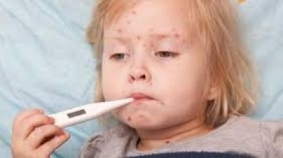 92 إصابة بالحصبة في القصرين 