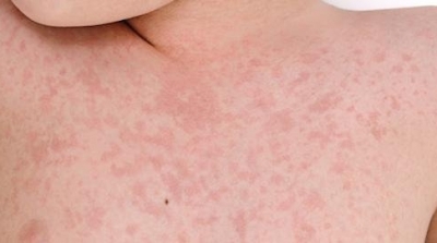 Rougeole : 580 contaminations enregistrées depuis janvier 2019