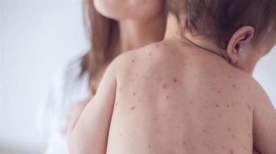 إيواء 12 رضيعا مصابا بالحصبة في مستشفى القيروان 