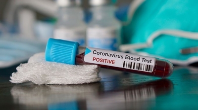 ارتفاع عدد الاصابات بكورونا الى 83 حالة في قبلي 