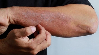 ظهور أعراض جديدة لفيروس كورونا : طفح جلدي و بثور و إحمرار في الجلد